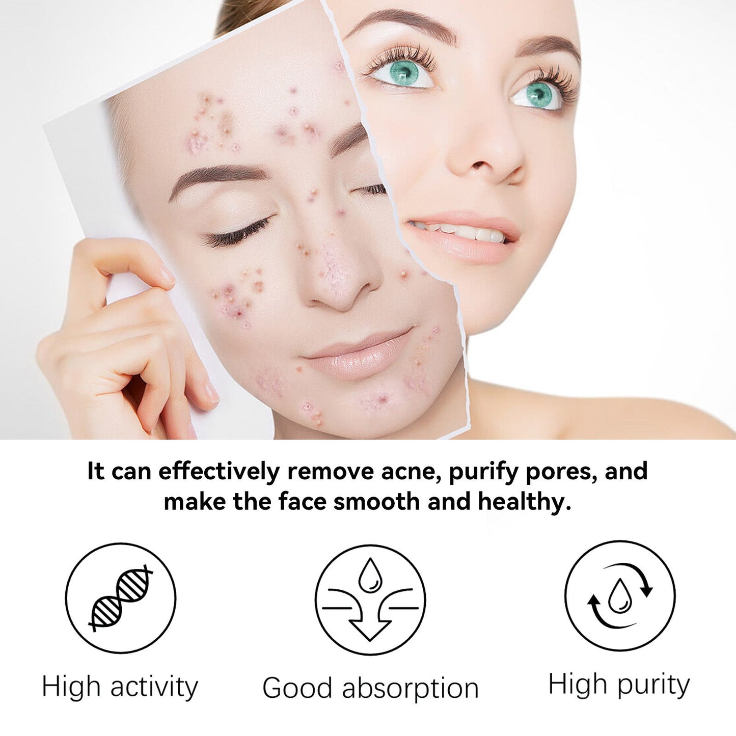 Herbal Acne Serum, Reduce Acne Pimples With A Comprehensive Moisturizing Moisturizer