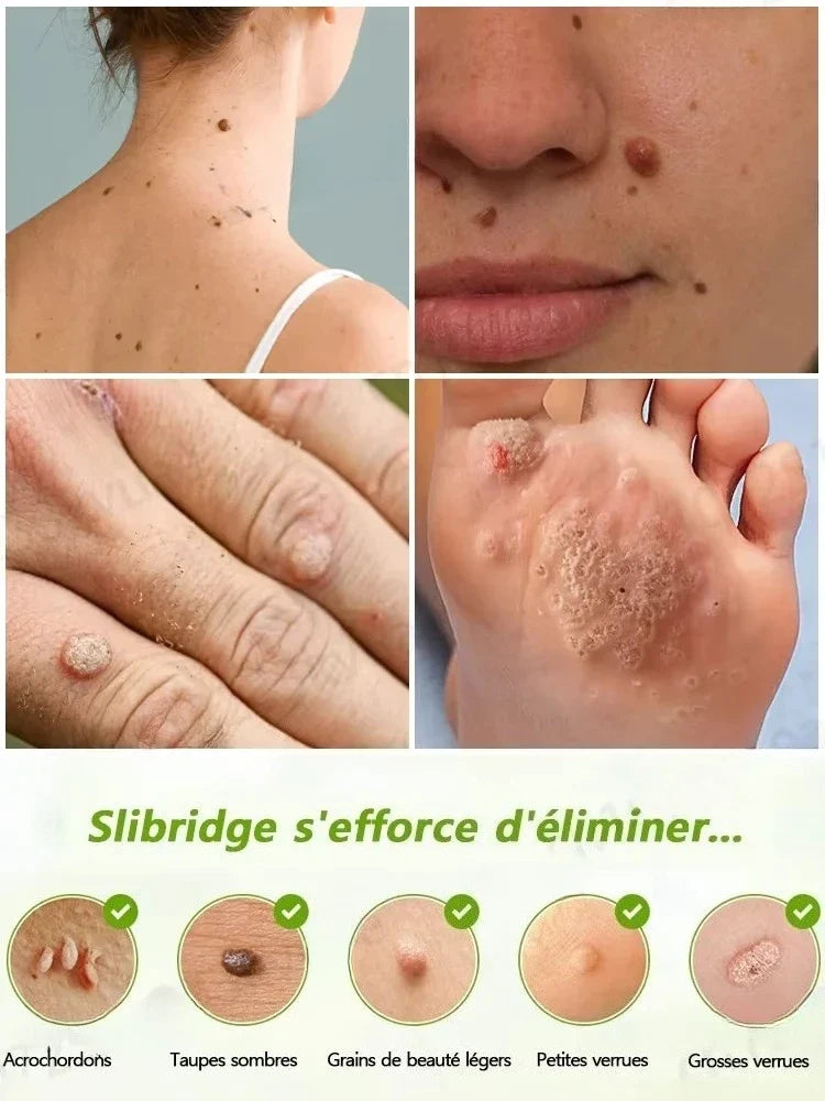 The longer these stubborn bumps are left untreated⸴ ᵗʰᵉ ʰᵃʳᵈᵉʳ ᵗʰᵉʸ ᵇᵉᶜᵒᵐᵉ ᵗᵒ ʳᵉᵐᵒᵛᵉ‧